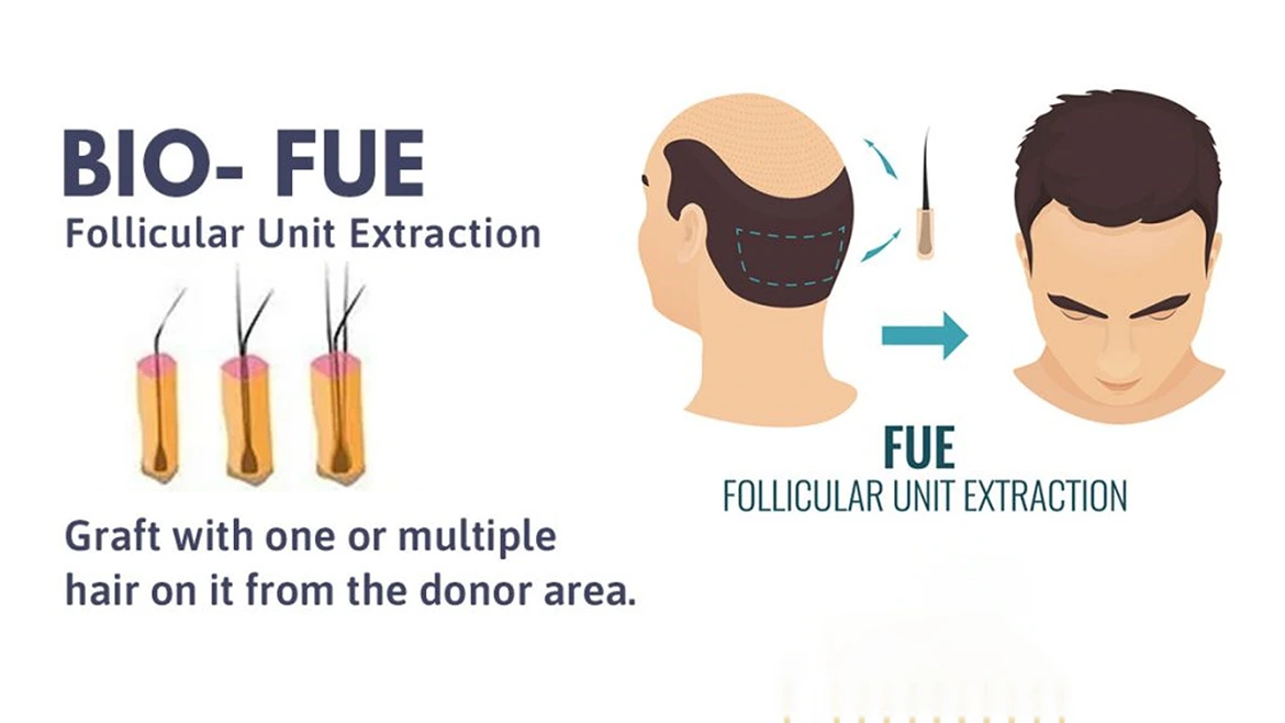 Bio FUE Hair Transplant Surgery | Hair Clinic in Vizag